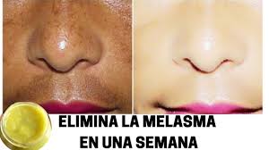 También se llama cloasma, o la pero finalmente te recomendamos conocer por que sale el paño en la cara, comprender que es el paño o melasma en la cara, para saber como quitar el. En 7 Dias Elimina Panos Melasma De Tu Piel Con Esta Crema Potente De La India Youtube