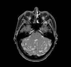 These are the symptoms to watch for according to where mbc. Brain Metastases From Breast Cancer Radiology Case Radiopaedia Org