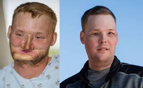 Face transplant allows this man to live a normal life. Hats off to all the  surgeons involved!