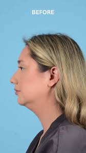 “Dr. Mentz gave me the most perfect nose and jawline— I have been wanting  to get this done forever and now that I have, I am so happy! If you are  wanting surgery, this is your sign to do it with the ...