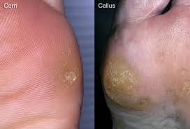 Dead skin on feet, and lotion doesn't help it go away? answered by dr. Pictures Of Common Foot Problems
