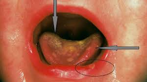 In seltenen fällen erkranken auch ältere kinder oder junge erwachsene daran. Gingivostomatitis Herpetica Altmeyers Encyclopedia Department Dermatology