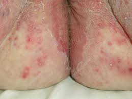 Drugs used to treat intertrigo. Medicine Diseases Ailments Skin Hair Nails Intertrigo Stock Photos And Pictures Science Photo Library