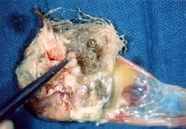 Maybe you would like to learn more about one of these? Cystic Teratoma Practice Essentials Background Pathophysiology