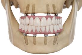 Full Arch Replacement - Elite Dental Specialists | Aurora St. Charles  Plainfield Naperville Glen Ellyn IL
