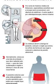 Hernia Incisional Saiba Como E A Cirurgia A Qual Bolsonaro Sera Submetido Saude E Ciencia Extra Online