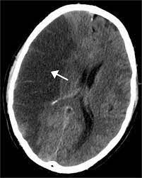 It occurs when something stops blood flow in the brain. Stroke Wikipedia