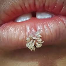 Image result for verrucae filiformes