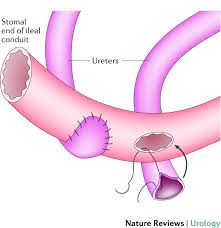 Incontinent urinary diversion was first described by bricker in 1950. Getting Out Of A Tight Spot An Overview Of Ureteroenteric Anastomotic Strictures Nature Reviews Urology