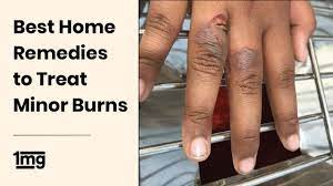 Best Home Remedies To Treat Minor Burns | 1Mg - Youtube