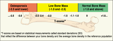 What Do Bmd Test Results Mean Nysopep Osteoporosis