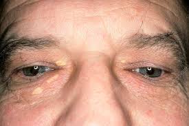 Image result for xanthelasma of eyelid