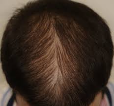 Common balding (androgenetic alopecia) occurs in men and women and is due to the effect of testosterone metabolites in genetically susceptible hair follicles. Pediatric Androgenetic Alopecia A Review Journal Of The American Academy Of Dermatology