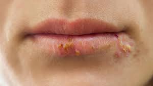 Understanding democratic rules of order. Does Herpes Cause Alzheimer S Science Research News Frontiers