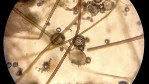 O que é o fungo preto. Suspeita De Fungo Preto Em Paciente Diagnosticado Com Covid E Investigada Em Santa Catarina Portal Paraiba Com Brportal Paraiba Com Br