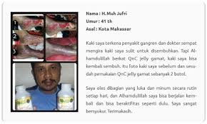 Bayangkan sehelai kertas diletak minyak, pasti ianya kembang dan lembutserta mudah koyak apabila dicakar. Obat Kulit Paling Manjur Dalam 1 Minggu Sembuh Total Promo Qnc Untuk Bulan Oktober Saja Kumparan Com
