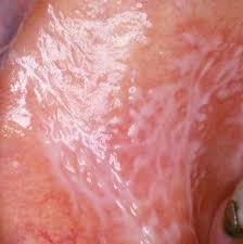 Ein auftreten im mittleren lebensalter ist typisch. Der Orale Lichen Planus Ein Update Zwp Online Das Nachrichtenportal Fur Die Dentalbranche