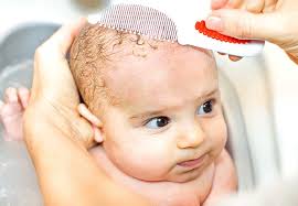Image result for Cradle Cap