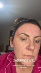 ✨Say goodbye to dull skin and hello to a radiant glow! Our home  microdermabrasion kit offers an amazing way to achieve exfoliated and  refreshed skin from the comfort of your own home. ⁠, ⁠, Uncover ...