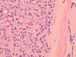 Hurthlezelladenom Hurthle Cell Adenoma Wikide Wiki