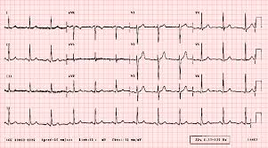 Ecglibrary Com Normal Adult 12 Lead Ecg