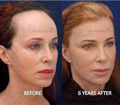 Forehead Reduction Surgery Hairline Lowering Surgery Before And After Photos Forehead Reduction Surgery Forehead Reduction Big Forehead