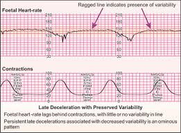 Image result for Late Deceleration