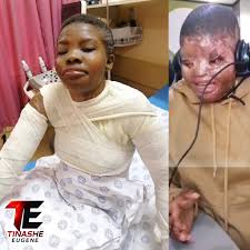 💔 FULL STORY | Mmapeu Left Scarred After Acid Attack Over Love Triangle 😭  Mmapeu Neo Hlanga (27) from Sekgweng Village in Limpopo is crying for  justice after surviving a brutal acid