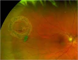 The most common reason for a rd is a retinal tear and the most common reason for a tear is a pvd. Safety And Efficacy Of The Use Of Navigated Retinal Laser As A Method Of Laser Retinopexy In The Treatment Of Symptomatic Retinal Tears Eye