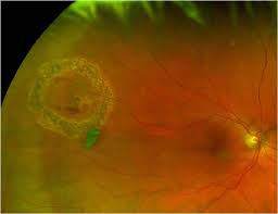 Learn what to expect from a dilated eye exam. Safety And Efficacy Of The Use Of Navigated Retinal Laser As A Method Of Laser Retinopexy In The Treatment Of Symptomatic Retinal Tears Eye