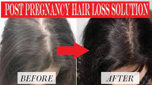 After pregnancy, hormones like estrogen, oxytocin and progesterone the answer is no. How To Stop Hair Fall After Pregnancy Post Pregnancy Hair Loss Prevention Youtube
