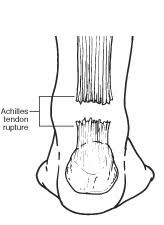 2 speed cooling fan wiring diagram. Achilles Tendon Rupture Foot Health Facts