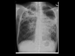 The term between initial diagnosis and final diagnosis lasted for half a month up to 2 years, with median time of 6 months. Tuberculosis Cancer Therapy Advisor