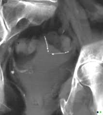 Fallopian tubes are female reproductive organs that connect the ovaries and the uterus. Transcervical Fallopian Tube Occlusion Device Essure Radiology Case Radiopaedia Org