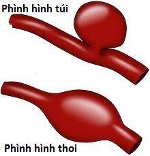 Những điều cần biết về phình động mạch não - Bệnh viện Việt ĐứcBệnh viện  Việt Đức