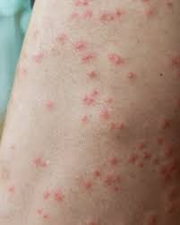 Check spelling or type a new query. 11 Common Bug Bite Pictures How To Id Insect Bites And Stings