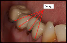 The symptoms of a cavity will depend on how large it is and where it is in your mouth. What A Crown Can Get A Cavity On It Summit Dental