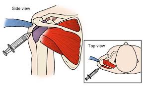 The subacromial bursa lies on the top portion of the supraspinatus tendon. Rotator Cuff Tears Orthoinfo Aaos