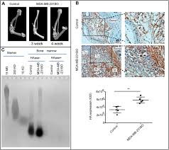 Its two main characteristics are uncontrolled growth of the cells in the human body and the ability of these cells to migrate from the original site and spread to distant sites. Remodelling Of The Bone Marrow Microenvironment By Stromal Hyaluronan Modulates The Malignancy Of Breast Cancer Cells Cell Communication And Signaling Full Text