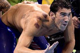 It caught people's attention this week because the therapy often leaves. Hijama Therapy Takes Olympics By Storm Sports Business Recorder
