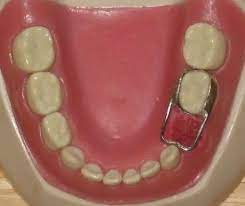Price Of Space Retainer For Children Ortodontia Protese Dentaria Clinica Dental