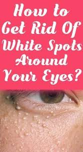 How To Get Rid Of Those White Spots Around Your Eyes Diy Health Tips Spots On Face Brown Spots On Face Get Rid Of Warts