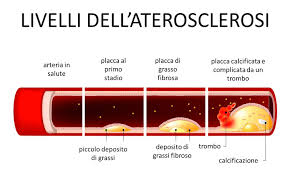Quindi è buona regola sottoporsi ad esami clinici di controllo ogni sei mesi o ogni anno. Cibi Da Evitare Per Il Colesterolo Alto