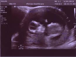 Fetal Ultrasound Image Gallery Fetal Pictures Of Ultrasound