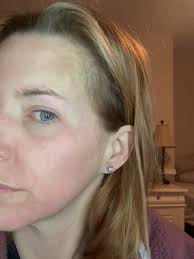 ✨ Peel Progress in Action! ✨, Check out these 3 videos showing the  real-time transformation from a SkinCeuticals Smart TCA Chemical Peel! 🧪,  We know chemical peel might sound a little intense—but ...