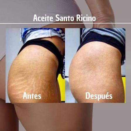 💥 ¿Quieres eliminar tus estrías? ¡Te contamos cómo! 💥 El Aceite Santo  Ricino es un potente regenerador que nutre e hidrata tu piel profundamente.  🌿 Penetra fácilmente en la piel. Ayuda a