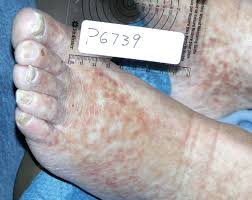 Ulcers And Gangrene In The Hands And Feet Of A 56 Year Old Man