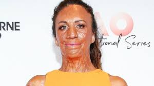 After suffering terrible burn injuries, turia was left with severe scaring on her face and body. I Grew Him Proud Mum Turia Pitt Shares Adorable New Photo Of Baby Son Starts At 60
