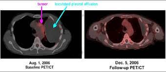 Request a free 2021 mesothelioma guide. A Complete Response Of Pleural Malignant Mesothelioma Patient 3 Pet Ct Download Scientific Diagram