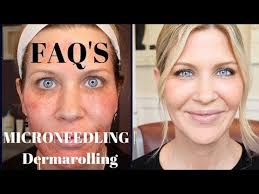 Microneedling & Dermarolling
